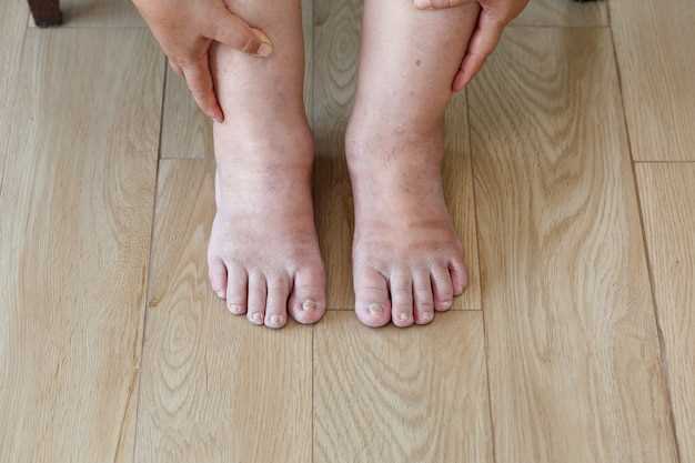 Профилактика грибка на ногах