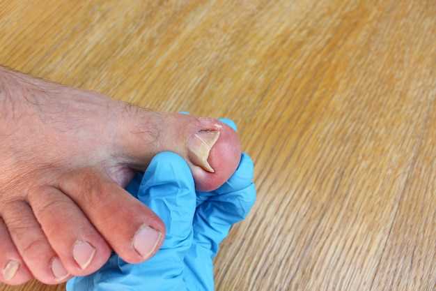 Стержневая мозоль на пальце ноги: причины и способы удаления